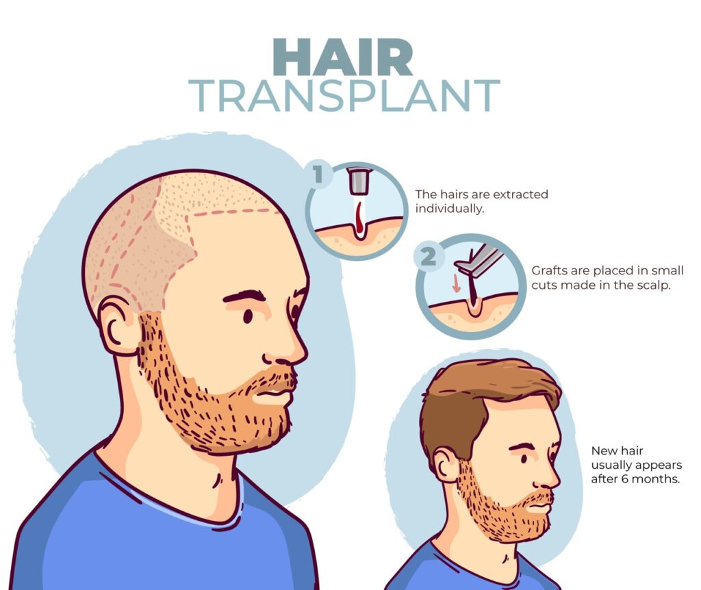 Graftlab Hair Transplant – Tanam Rambut Indonesia