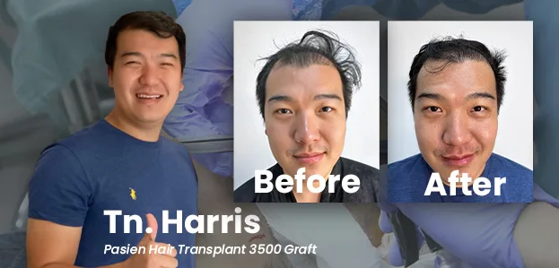 Before–After Harris sebagai Pasien Tanam Rambut 3500 Graft di Jakarta Selatan, Indonesia