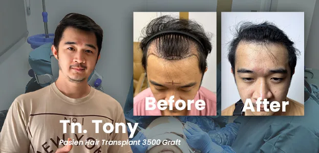 Before–After Tony sebagai Pasien Tanam Rambut 3500 Graft di Jakarta Selatan, Indonesia