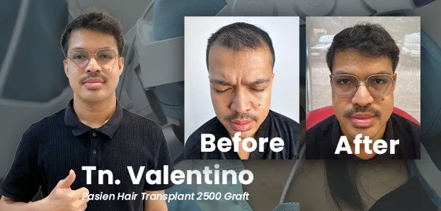 Before–After Valentino – Hair Transplant di Jakarta, Indonesia (Graftlab)