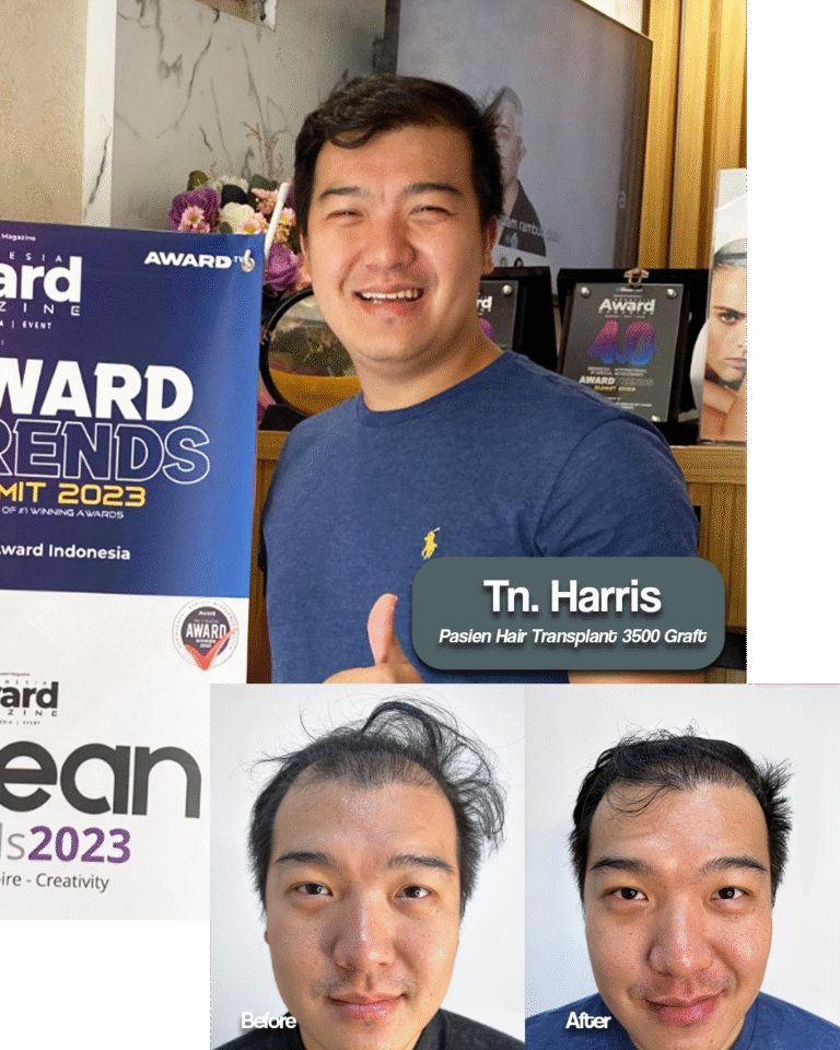 Harris Before After Graftlab Hair Transplant Jakarta Selatan di Indonesia