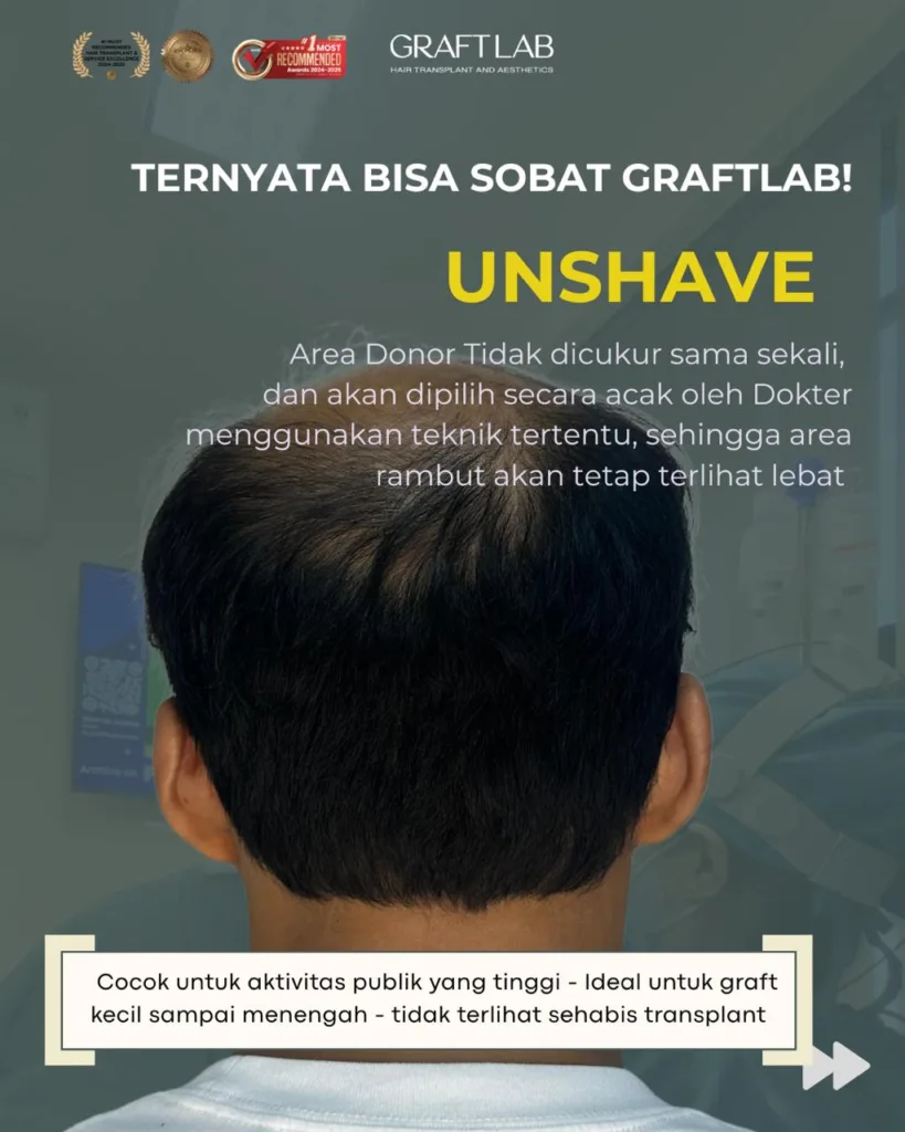 Kiri – Unshave, Area Donor Tidak Dicukur Sama Sekali di Graftlab Hair Transplant, Jakarta Selatan, Indonesia