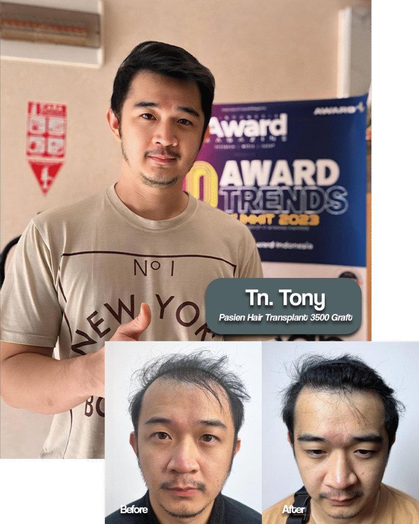 Tony Before After Graftlab Hair Transplant Jakarta Selatan di Indonesia