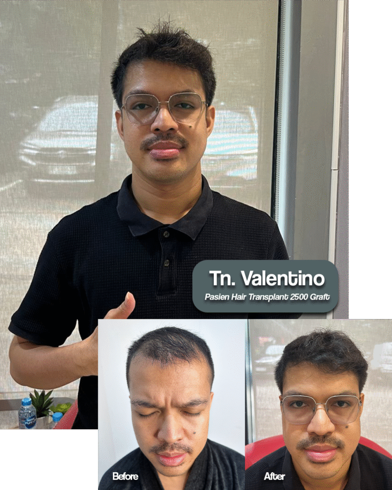 Valentino Before After Graftlab Hair Transplant Jakarta Selatan di Indonesia